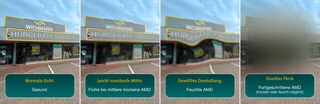Wichmann Pein AMD Makuladegeneration Verlauf